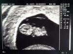 Ultraschall, Baby 10. Schwangerschaftswoche